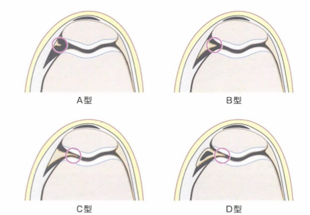 原因と危険因子